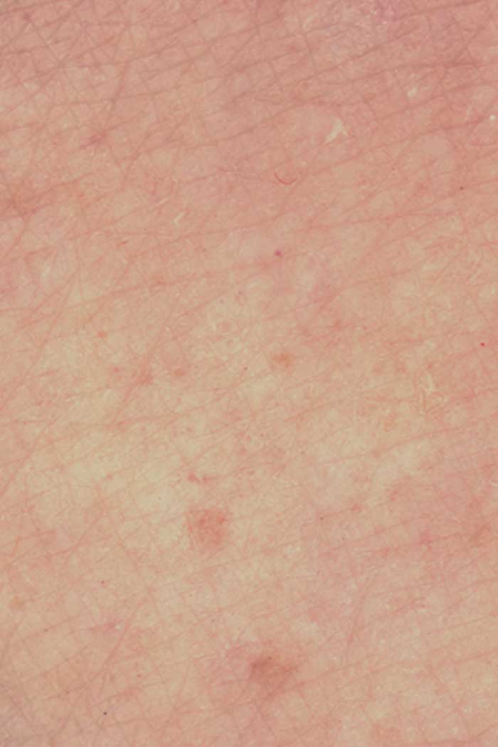 Dry skin as a sign of stressed skin